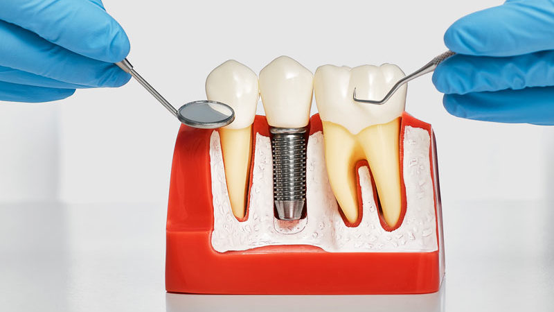 a dental implant bone cutaway model showing a single post dental implant