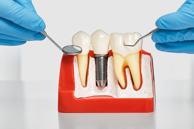 a dental implant bone cutaway model showing a single post dental implant