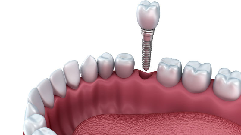 a single dental implant and post being placed into a lower jaw.