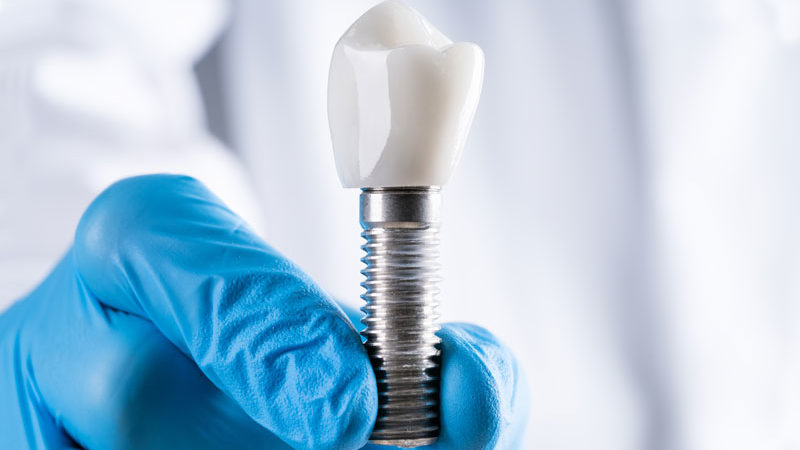 an image of a dental professionals gloved fingers holding a single dental implant