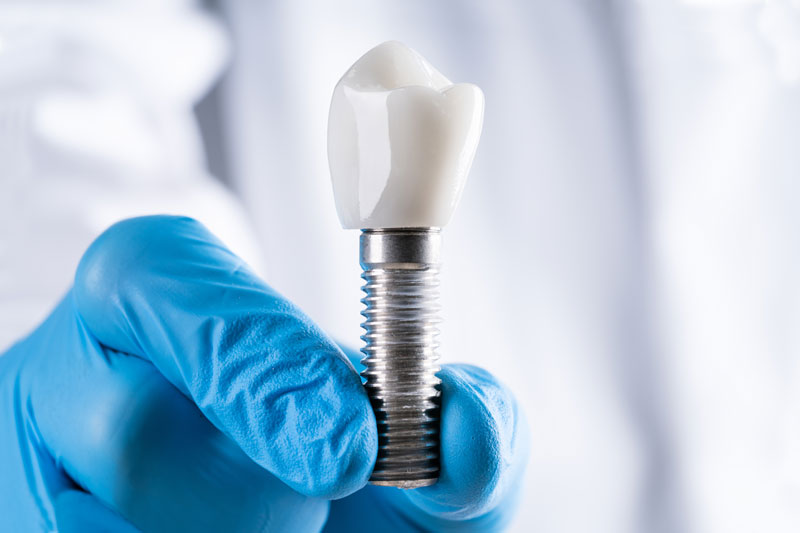 an image of a dental professionals gloved fingers holding a single dental implant