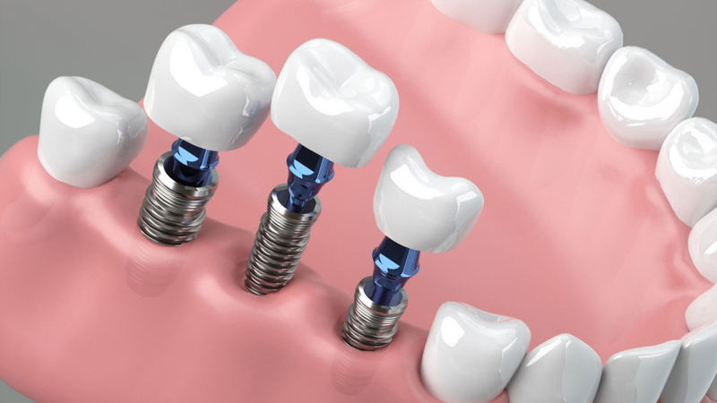 three single dental implants being placed into a jaw model.