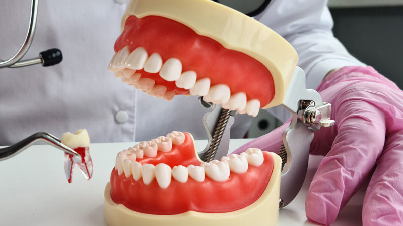 a full mouth model showcasing a single tooth extraction.