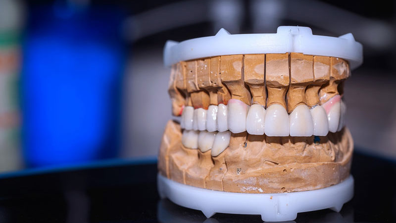 a full mouth dental implant model with dental crowns and a dental bridge.