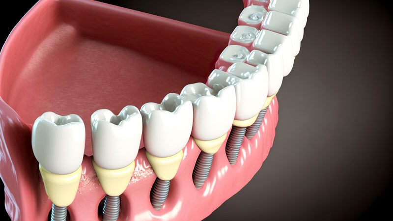 Close-up 3d model of a dental implant