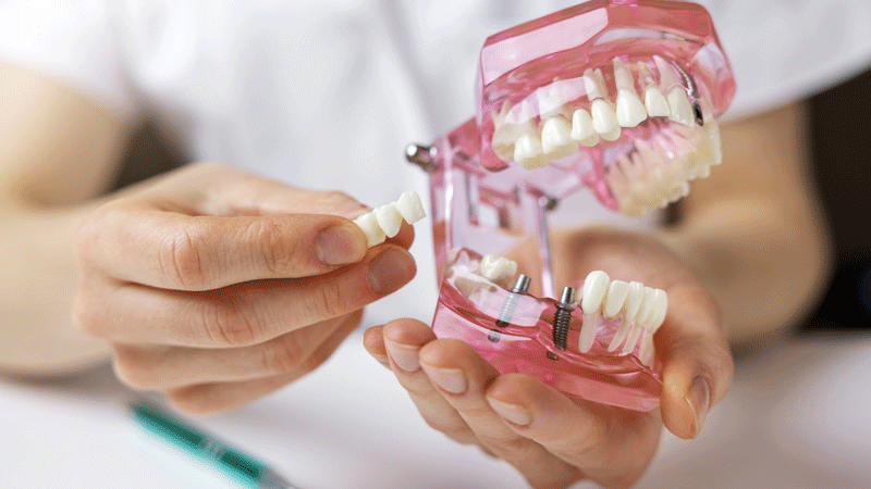 dentist implantologist showing dental bridge implant technology on human tooth jaw model.
